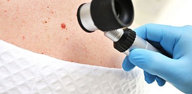 Znamiona skórne a ryzyko nowotworowe – kiedy wskazana jest dalsza diagnostyka?