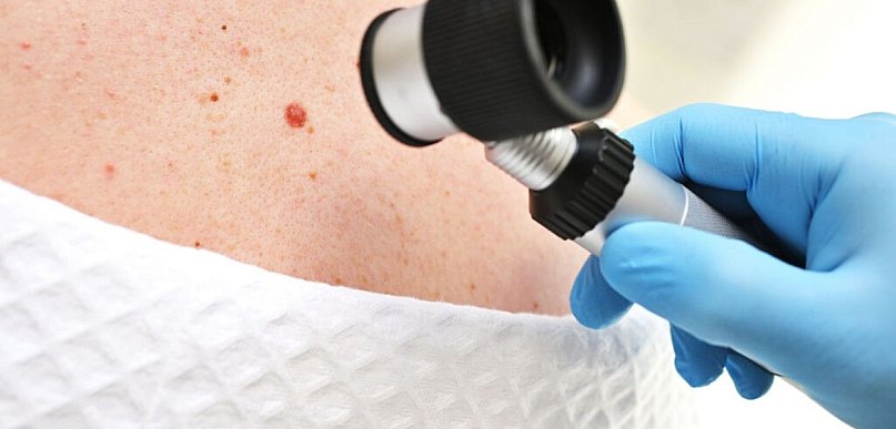 Znamiona skórne a ryzyko nowotworowe – kiedy wskazana jest dalsza diagnostyka?