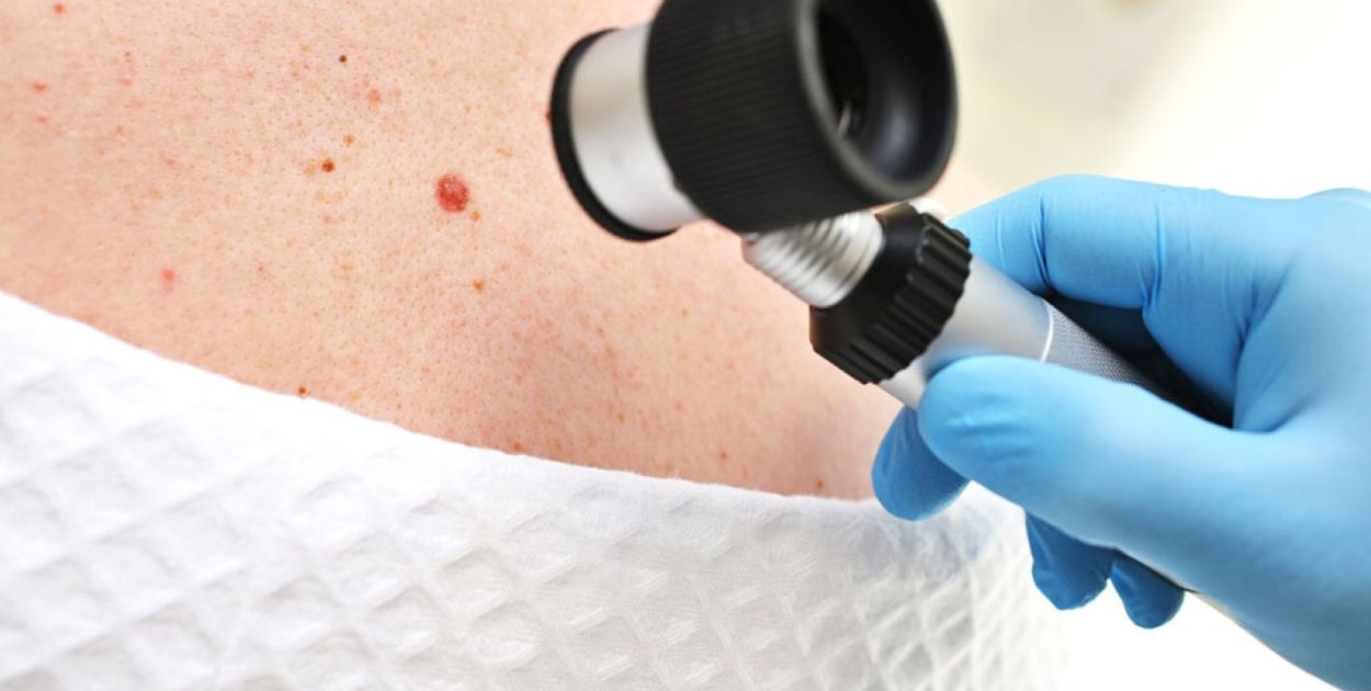 Znamiona skórne a ryzyko nowotworowe – kiedy wskazana jest dalsza diagnostyka?
